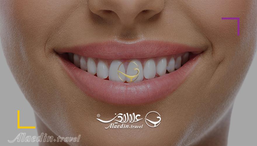 Cosmetic Dentistry in Iran | Alaedin Travel